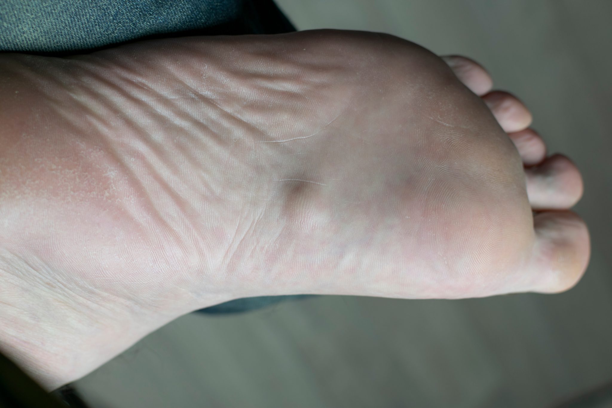 plantar-fibromas-archives-university-podiatry-associates